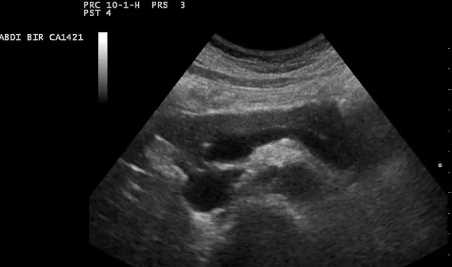 Tumore del pancreas, nuova tecnica per curare neoplasia inoperabile