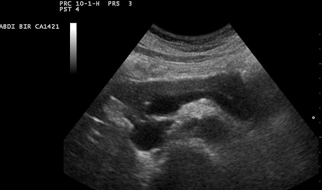 Tumore del pancreas, nuova tecnica per curare neoplasia inoperabile