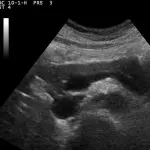 Tumore del pancreas, nuova tecnica per curare neoplasia inoperabile