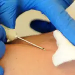 Pertosse, paura in Veneto per tre neonate contagiate